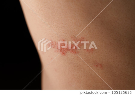 Man with shingles disease, skin infected with Herpes zoster, virus, Healthcare and medical. Man with shingles disease, skin infected with Herpes zoster, virus, Healthcare and medical. 105125655
