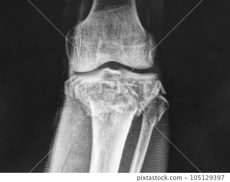 X-ray image of tibial plateau fracture and fibular head fracture X-ray image of tibial plateau fracture and fibular head fracture 105129397