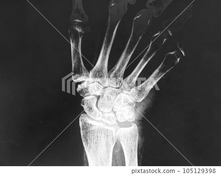 X-ray image of carpals bone ,AP view X-ray image of carpals bone ,AP view 105129398