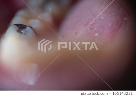 箍牙 牙齒 齒輪 105143231