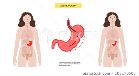Endoscopic sleeve gastroplasty Endoscopic sleeve gastroplasty 105170505