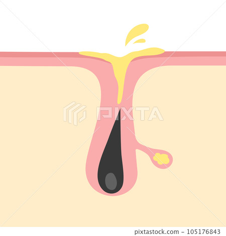 Image illustration of excessive secretion of sebum Image illustration of excessive secretion of sebum 105176843