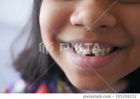 detail shot of child with teeth missing detail shot of child with teeth missing 105209152