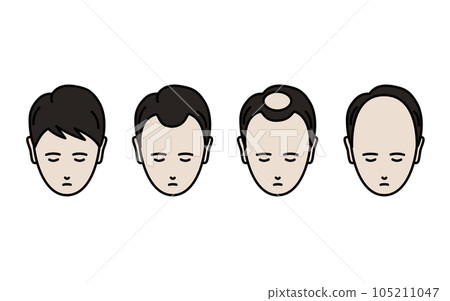 AGA, illustration of a man with progressive alopecia 105211047