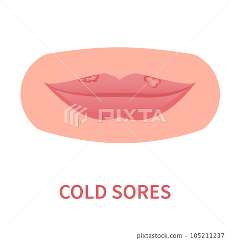 Cold sores outbreak of herpes HSV on lips 105211237