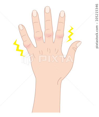 Bouchard節點第二關節腫脹平面圖彩色透明png背景透明 Bouchard節點第二關節腫脹平面圖彩色透明png背景透明 105215346