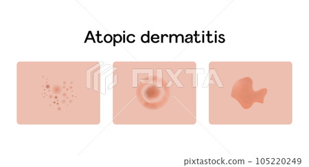 Atopic dermatitis examples vector illustration design, medical problems 105220249