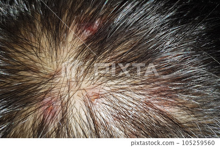 Scabs On The Scalp, wound on the scalps or Lichen planus follicularis capillitii, itch on the scalps, caused by diabetes on adults 105259560