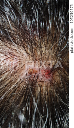 Scabs On The Scalp, wound on the scalps or Lichen planus follicularis capillitii, itch on the scalps, caused by diabetes on adults Scabs On The Scalp, wound on the scalps or Lichen planus follicularis capillitii, itch on the scalps, caused by diabetes on adults 105259573