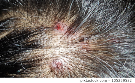 Scabs On The Scalp, wound on the scalps or Lichen planus follicularis capillitii, itch on the scalps, caused by diabetes on adults Scabs On The Scalp, wound on the scalps or Lichen planus follicularis capillitii, itch on the scalps, caused by diabetes on adults 105259582