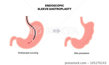 Endoscopic sleeve gastroplasty 105270143