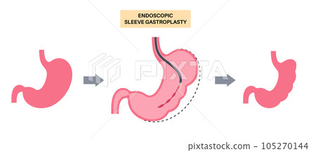 Endoscopic sleeve gastroplasty 105270144