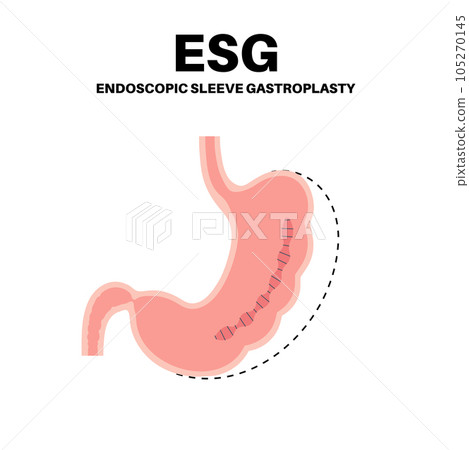 Endoscopic sleeve gastroplasty Endoscopic sleeve gastroplasty 105270145