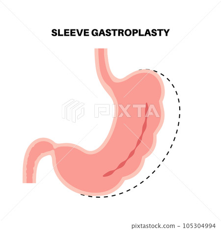 Endoscopic sleeve gastroplasty 105304994
