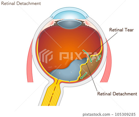 retinal tear, retinal detachment, eye, illustration retinal tear, retinal detachment, eye, illustration 105309285