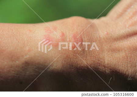 caterpillar bite marks caterpillar bite marks 105316600