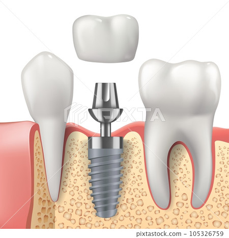 Teeth and dental implant realistic vector design of dentistry. 3d tooth, denture crown, jaw bones and healthy roots, implant screw and abutment, healthcare, dentist and orthodontist treatment 105326759