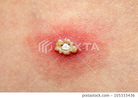 Treatment of ulcers from chicken pox. A large purulent sore chicken pox on the skin of a child, an allergic reaction in a person 105333436