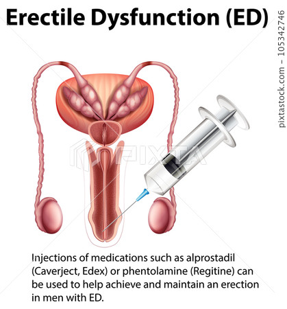 Erectile Dysfunction (ED) infographic with explanation 105342746