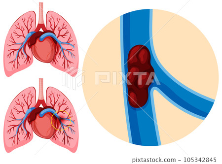 Human anatomy pulmonary embolism 105342845