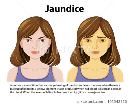 Jaundice disease vector concept 105342850