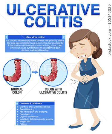 Ulcerative Colitis Symptoms Infographic - Stock Illustration [105343829 ...