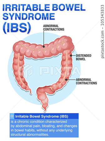 Irritable Bowel Syndrome (IBS) Infographic Irritable Bowel Syndrome (IBS) Infographic 105343833