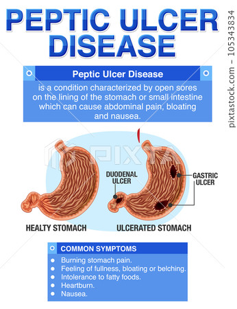 Peptic Ulcer Disease Explained Infographic Peptic Ulcer Disease Explained Infographic 105343834