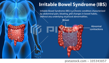 Irritable Bowel Syndrome (IBS) Infographic 105343857