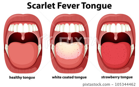 Scarlet fever tongue symptoms Scarlet fever tongue symptoms 105344462