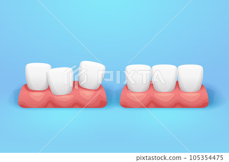 straight and crooked teeth on blue back straight and crooked teeth on blue back 105354475
