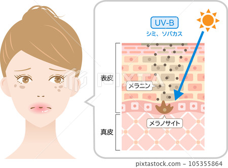 紫外線 B 波瑕疵、女性和皮膚的雀斑橫截面 105355864