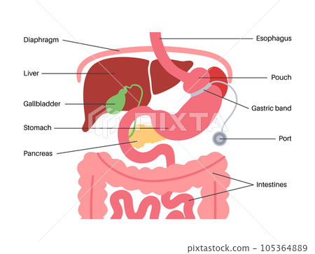 Gastric band poster 105364889