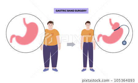 Gastric band poster Gastric band poster 105364893