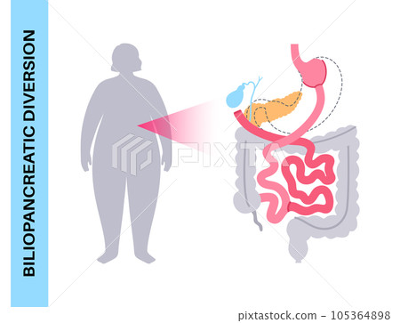 Biliopancreatic diversion procedure 105364898