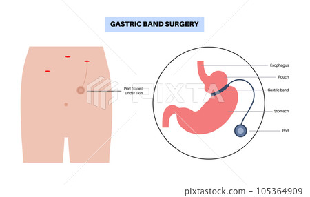 Gastric band poster 105364909