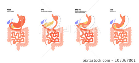 Bariatric surgery poster Bariatric surgery poster 105367801
