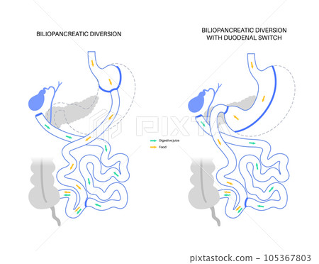 Biliopancreatic diversion procedure Biliopancreatic diversion procedure 105367803