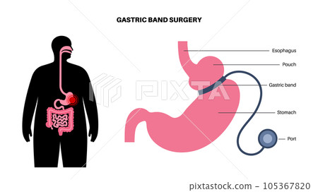 Gastric band poster Gastric band poster 105367820