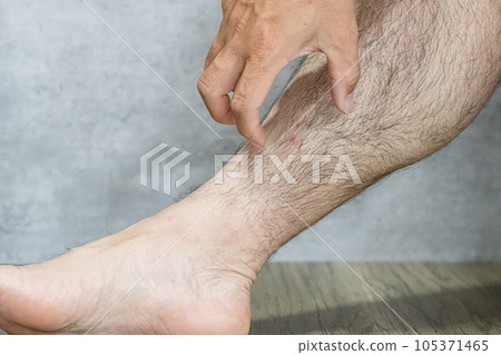 Scratching an insect bite 105371465