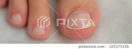 Damaged toenail close up, shallow depth of field. Damaged toenail close up, shallow depth of field. 105375336