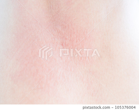 Woman with Urticaria on Skin ,Non-Lethal Type from Food and Air Poisoning Health,Medicine Body Care Disease Lilness Air,Infection Pain sickness. 105376004