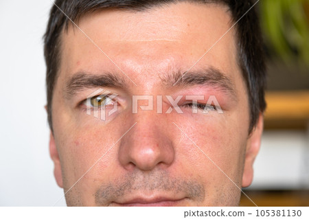 A red swollen eyelid on a man's face in close-up is an allergy to an insect bite. Allergic reaction to blood-sucking insects 105381130
