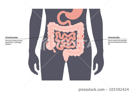Diverticulitis and diverticulosis Diverticulitis and diverticulosis 105392424