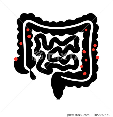 Diverticulitis and diverticulosis Diverticulitis and diverticulosis 105392430