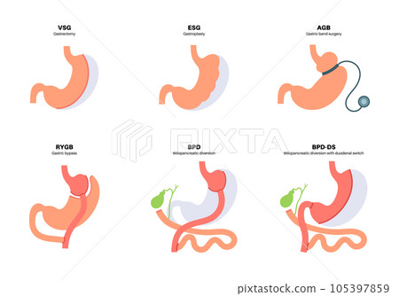 Bariatric surgery poster Bariatric surgery poster 105397859