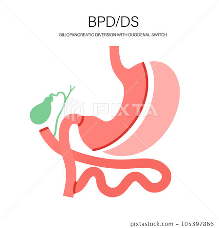 Biliopancreatic diversion procedure 105397866