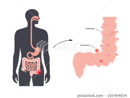 Diverticulitis and diverticulosis Diverticulitis and diverticulosis 105404634