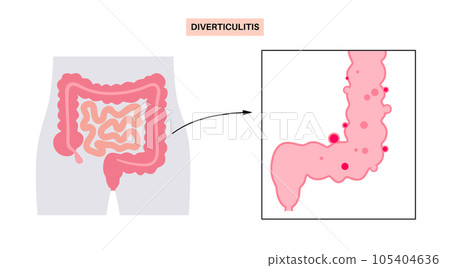 Diverticulitis and diverticulosis Diverticulitis and diverticulosis 105404636