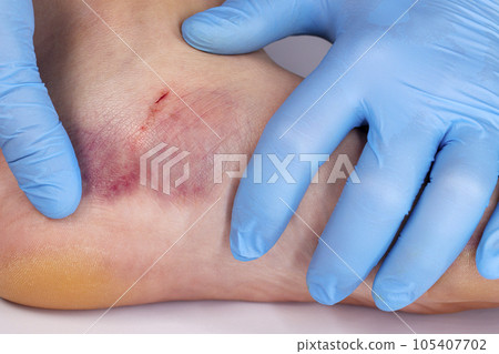 Doctor is examining an injured foot with bruise and scratch Doctor is examining an injured foot with bruise and scratch 105407702